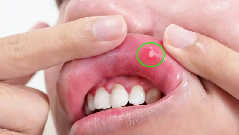 Vücudunuzdaki 5 B Vitamini Eksikliği Belirtisi: Sağlığınızı Tehdit Ediyor!