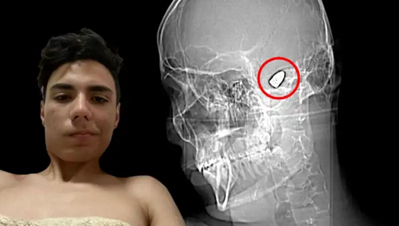 Kafasında Patlayıcı Taşıyan Genç: Bomba Tehditinin Ardındaki Korkunç Gerçekler