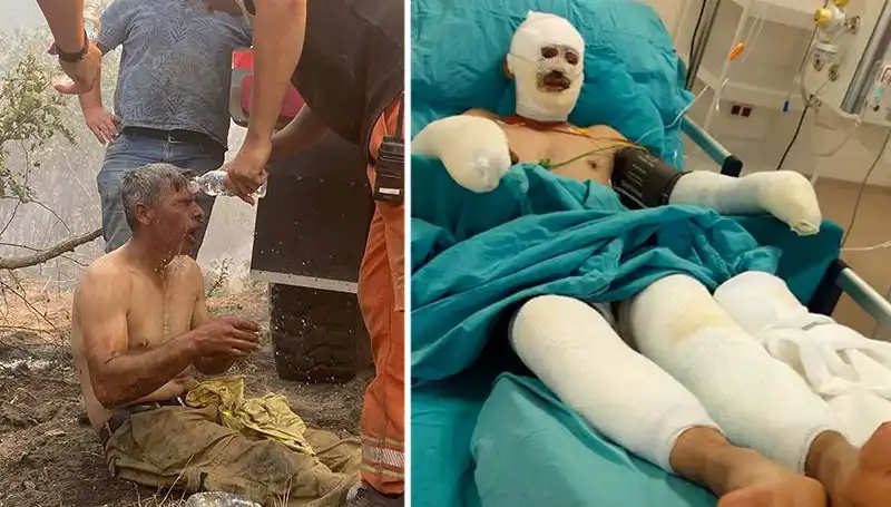Orman İşçisinin "Yanıyorum!" Feryadı: Tedavi Süreci Devam Ediyor
